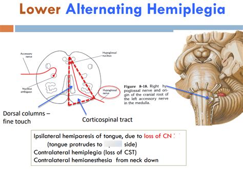 Lower Alternating Hemiplegia Diagram Quizlet Lower Alternating Hemiplegia Diagram Quizlet