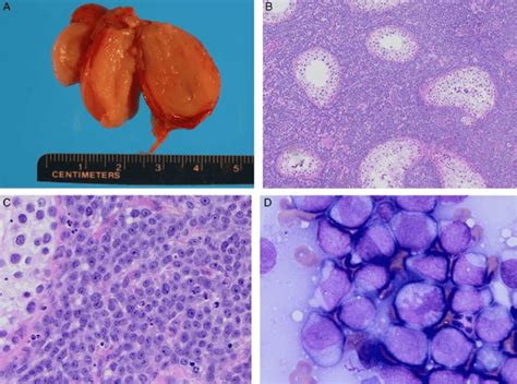 Testicular Myeloid Sarcoma The George Washington University School Of