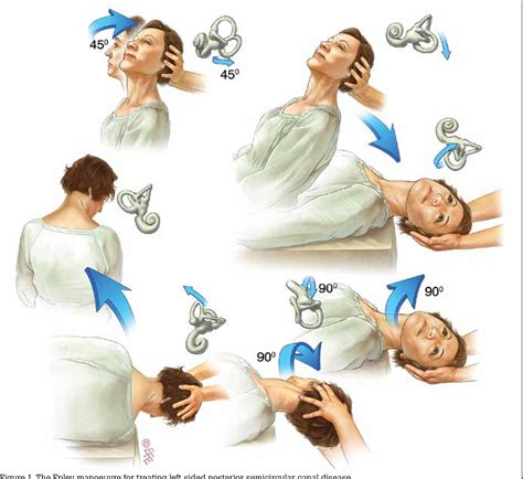 What Is Epley Maneuver For Vertigo Polfax What Is Epley Maneuver For Vertigo Polfax